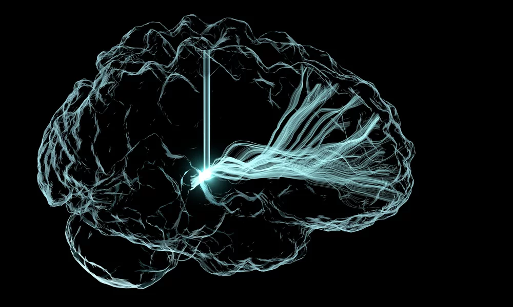 Deep Brain Stimulation Illustration